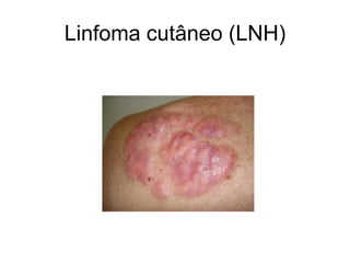 Linfoma cutâneo (LNH)
 