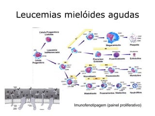 Leucemias mielóides agudas




            Imunofenotipagem (painel proliferativo)
 