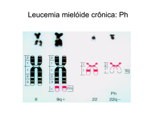 Leucemia mielóide crônica: Ph
 