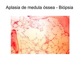 Aplasia de medula óssea - Biópsia
 