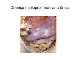 Doença mieloproliferativa crônica
 