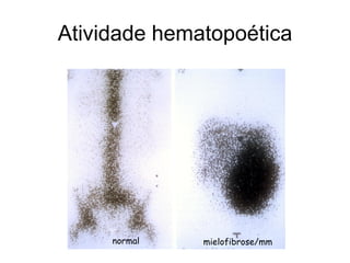 Atividade hematopoética




     normal   mielofibrose/mm
 