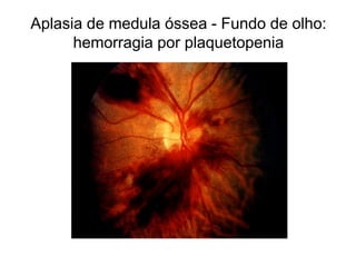 Aplasia de medula óssea - Fundo de olho:
      hemorragia por plaquetopenia
 
