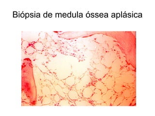 Biópsia de medula óssea aplásica
 