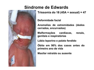 Trissomia do 18 (45A + sexual) = 47
Deformidade facial
Anomalias de extremidades (dedos
cerrados, encurvados)
Malformações cardíacas, renais,
genitais e respiratórias
Lábio leporino e palato fendido
Óbito em 90% dos casos antes do
primeiro ano de vida
Maxilar retraído ou ausente
Síndrome de Edwards
 