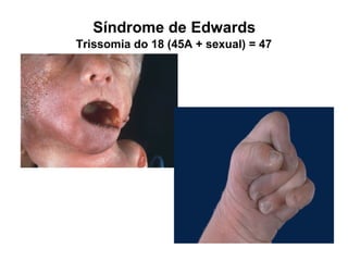 Trissomia do 18 (45A + sexual) = 47
Síndrome de Edwards
 