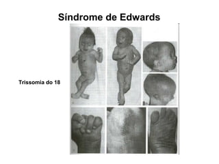 Síndrome de Edwards
Trissomia do 18
 