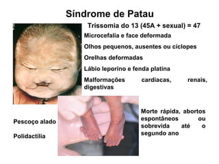 Trissomia do 13 (45A + sexual) = 47
Microcefalia e face deformada
Olhos pequenos, ausentes ou cíclopes
Orelhas deformadas
Lábio leporino e fenda platina
Malformações cardíacas, renais,
digestivas
Síndrome de Patau
Pescoço alado
Polidactilia
Morte rápida, abortos
espontâneos ou
sobrevida até o
segundo ano
 