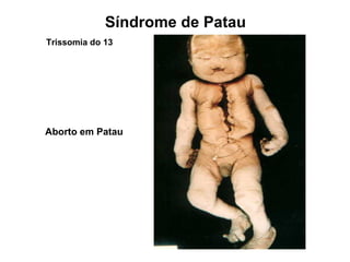 Aborto em Patau
Síndrome de Patau
Trissomia do 13
 