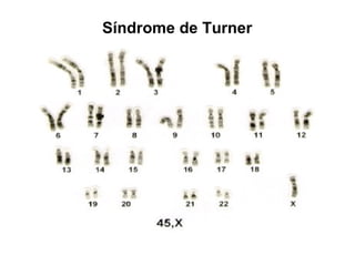 Síndrome de Turner
 