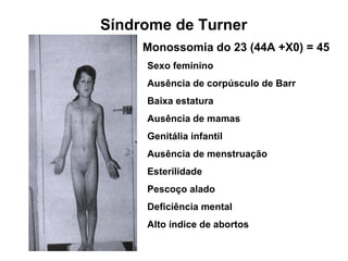 Monossomia do 23 (44A +X0) = 45
Sexo feminino
Ausência de corpúsculo de Barr
Baixa estatura
Ausência de mamas
Genitália infantil
Ausência de menstruação
Esterilidade
Pescoço alado
Deficiência mental
Alto índice de abortos
Síndrome de Turner
 