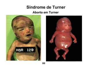 Aborto em Turner
Síndrome de Turner
X0
 