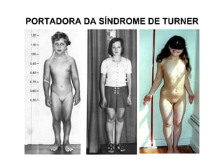 PORTADORA DA SÍNDROME DE TURNER
 