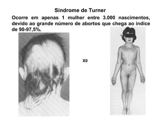Ocorre em apenas 1 mulher entre 3.000 nascimentos,
devido ao grande número de abortos que chega ao índice
de 90-97,5%.
Síndrome de Turner
X0
 