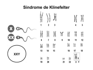 Síndrome de Klinefelter
XXY
 