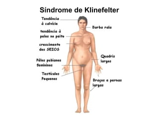 Síndrome de Klinefelter
 