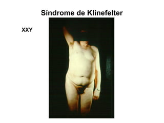 Síndrome de Klinefelter
XXY
 