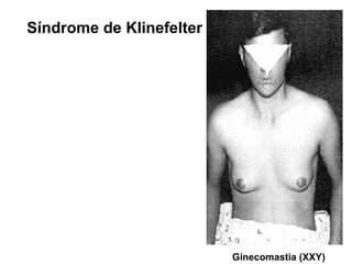 Ginecomastia (XXY)
Síndrome de Klinefelter
 
