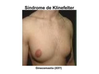 Ginecomastia (XXY)
Síndrome de Klinefelter
 
