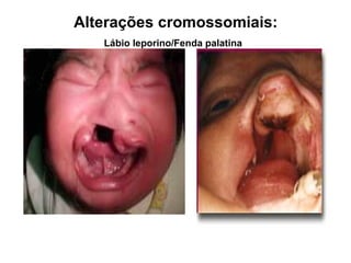 Lábio leporino/Fenda palatina
Alterações cromossomiais:
 