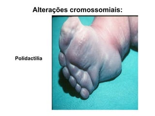 Polidactilia
Alterações cromossomiais:
 