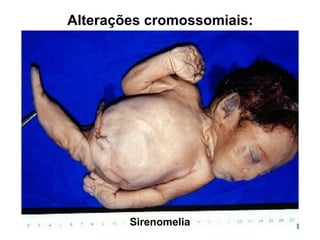 Sirenomelia
Alterações cromossomiais:
 