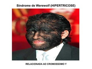 RELACIONADA AO CROMOSSOMO Y
Síndrome de Werewolf (HIPERTRICOSE)
 