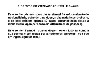Síndrome de Werewolf (HIPERTRICOSE)
Este senhor, de seu nome Jesús Manuel Fajardo, e alemão de
nacionalidade, sofre de uma doença chamada hypertrichosis,
e da qual existem apenas 50 casos documentados desde a
idade média (aparece 1 caso em 340 milhões de pessoas).
Este senhor é também conhecido por homem lobo, tal como a
sua doença é conhecida por Síndrome de Werewolf (wolf que
em inglês significa lobo).
 