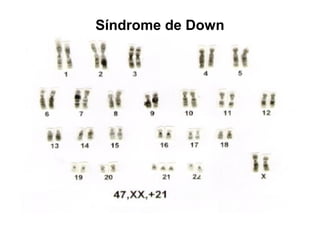 Síndrome de Down
 