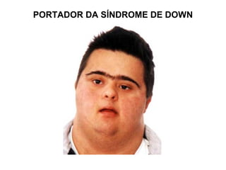 PORTADOR DA SÍNDROME DE DOWN
 
