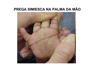PREGA SIMIESCA NA PALMA DA MÃO
 