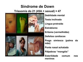 Trissomia do 21 (45A + sexual) = 47
Debilidade mental
Testa inclinada
Língua protraída
Estrabismo
Eritema (vermelhidão)
Defeitos cardíacos
Prega simiesca (palma da
mão)
Ponte nasal achatada
Pálpebras “mongóis”
Esterilidade comum nos
meninos
Síndrome de Down
 