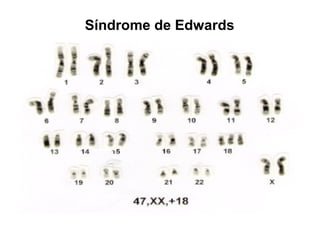 Síndrome de Edwards
 