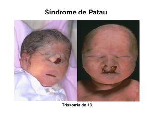 Síndrome de Patau
Trissomia do 13
 