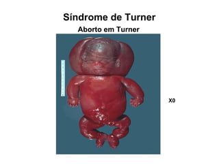Aborto em Turner
Síndrome de Turner
X0
 
