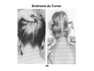 Síndrome de Turner
X0
 