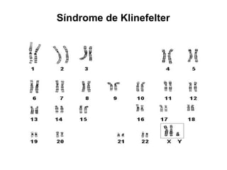 Síndrome de Klinefelter
 