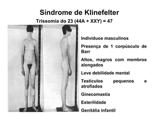 Trissomia do 23 (44A + XXY) = 47
Indivíduos masculinos
Presença de 1 corpúsculo de
Barr
Altos, magros com membros
alongados
Leve debilidade mental
Testículos pequenos e
atrofiados
Ginecomastia
Esterilidade
Genitália infantil
Síndrome de Klinefelter
 