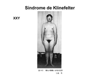 Síndrome de Klinefelter
XXY
 