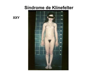 Síndrome de Klinefelter
XXY
 