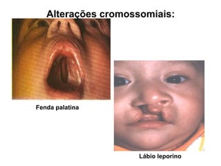 Fenda palatina
Alterações cromossomiais:
Lábio leporino
 