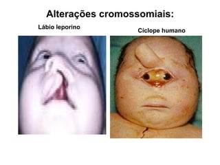 Lábio leporino
Cíclope humano
Alterações cromossomiais:
 