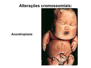 Acondroplasia
Alterações cromossomiais:
 