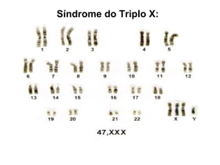 Síndrome do Triplo X:
 