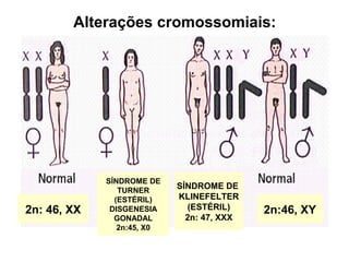 SÍNDROME DE
TURNER
(ESTÉRIL)
DISGENESIA
GONADAL
2n:45, X0
2n: 46, XX
SÍNDROME DE
KLINEFELTER
(ESTÉRIL)
2n: 47, XXX
2n:46, XY
Alterações cromossomiais:
 