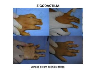 ZIGODACTILIA
Junção de um ou mais dedos
 