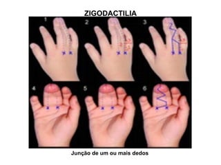 ZIGODACTILIA
Junção de um ou mais dedos
 