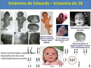 Síndrome de Edwards – trissomia do 18
Várias mal formações e deformidades
Expectativa de vida curta
Implantação baixa da orelha
 