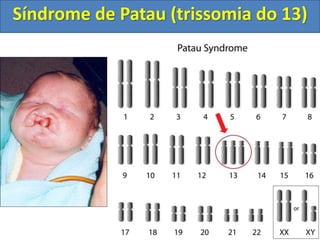 Síndrome de Patau (trissomia do 13)
 