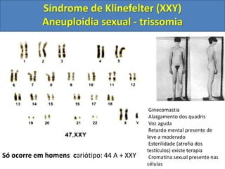 Só ocorre em homens cariótipo: 44 A + XXY
Ginecomastia
Alargamento dos quadris
Voz aguda
Retardo mental presente de
leve a moderado
Esterilidade (atrofia dos
testículos) existe terapia
Cromatina sexual presente nas
células
Síndrome de Klinefelter (XXY)
Aneuploidia sexual - trissomia
 